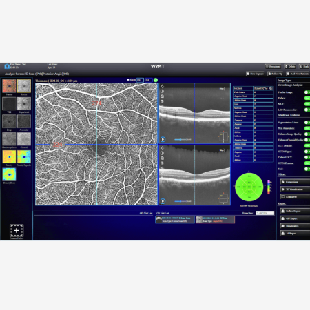 OCT/A EYEFOS 1K cu AI, tomograf în coerență optică 4K pentru diagnostic retinian și glaucom [6]