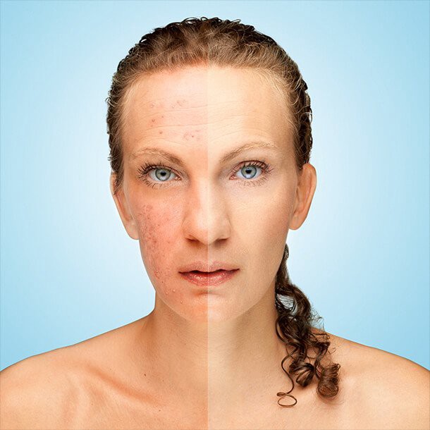 cbd pentru afectiuni piele acnee psoriazis neurodermatita