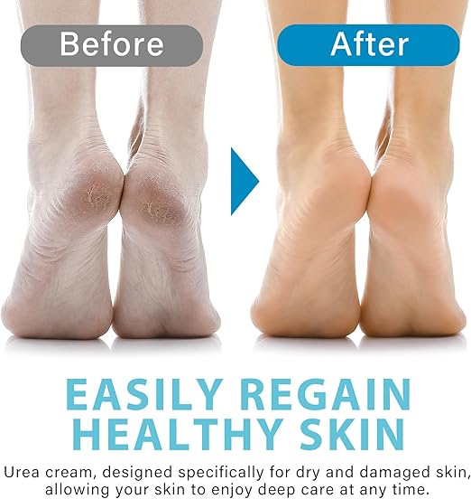 Cremă exfoliantă pentru bătături cu Acid Salicilic & Acid Hialuronic – hidratare și netezire intensă [3]