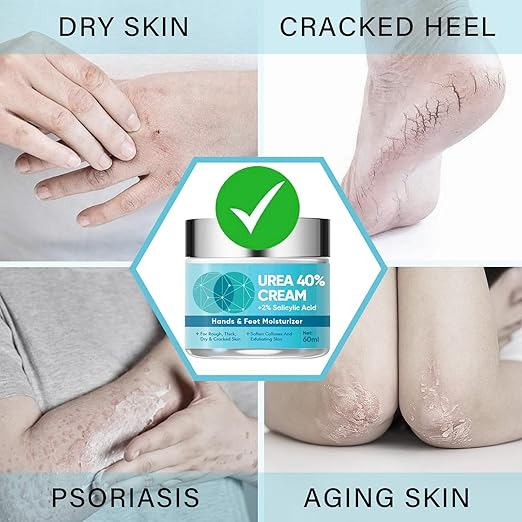 Cremă exfoliantă pentru bătături cu Acid Salicilic & Acid Hialuronic – hidratare și netezire intensă [7]