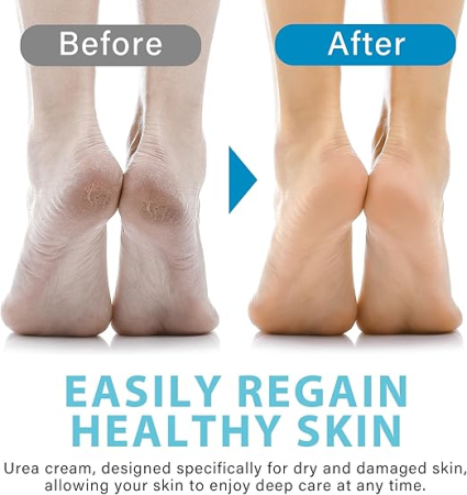 Cremă exfoliantă pentru bătături cu Acid Salicilic & Acid Hialuronic – hidratare și netezire intensă [2]