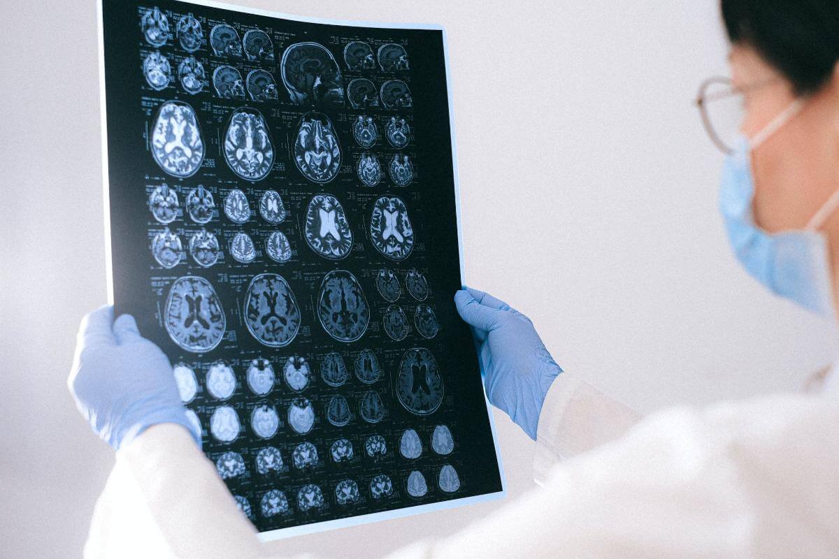 Alzheimer si CBD – beneficiile dovedite ale acestei substante in lupta cu o boala incurabila