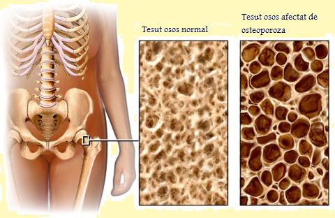 Osteoporoza: Ce Este și Cum o Poți Trata Natural? 15 Remedii Eficiente pe Care Să le Încerci