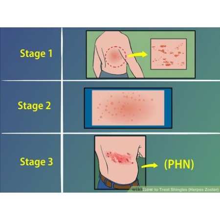 Afecțiuni infecțioase-Tratamente, Retete si Remedii naturiste - Herpes Zoster sau Zona Zoster.Tratament naturist, pachet complet 