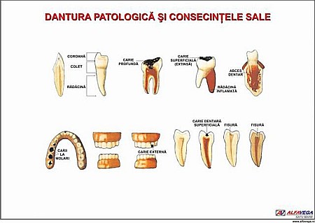PLANSE ANATOMIE - Patologia dinților