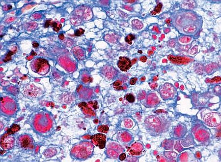 Patologii histologice umane – set 15 preparate microscopice [5]