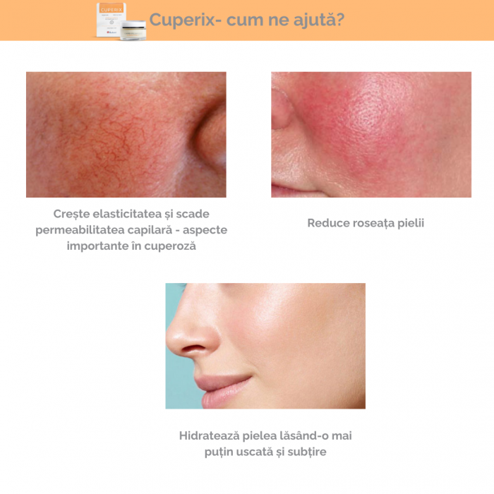 Pachet anticuperoza Cuperix +C [3]