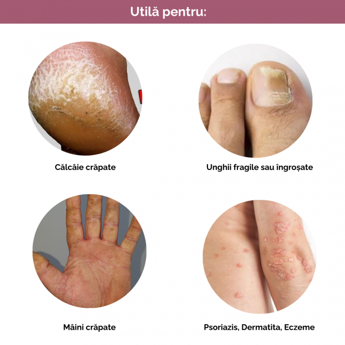 Ureea 20% - Crema cu Uree, Vitamina A si E - 100 ML [4]