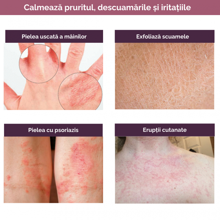 Ureea 20% - Crema cu Uree, Vitamina A si E - 100 ML [6]