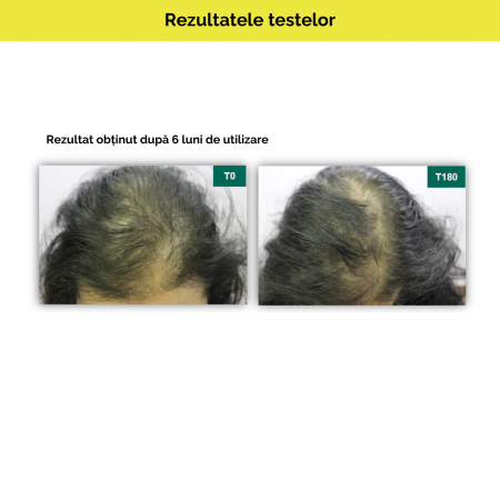 Pachet promotional anticadere Capilforte 2+1 GRATIS [6]