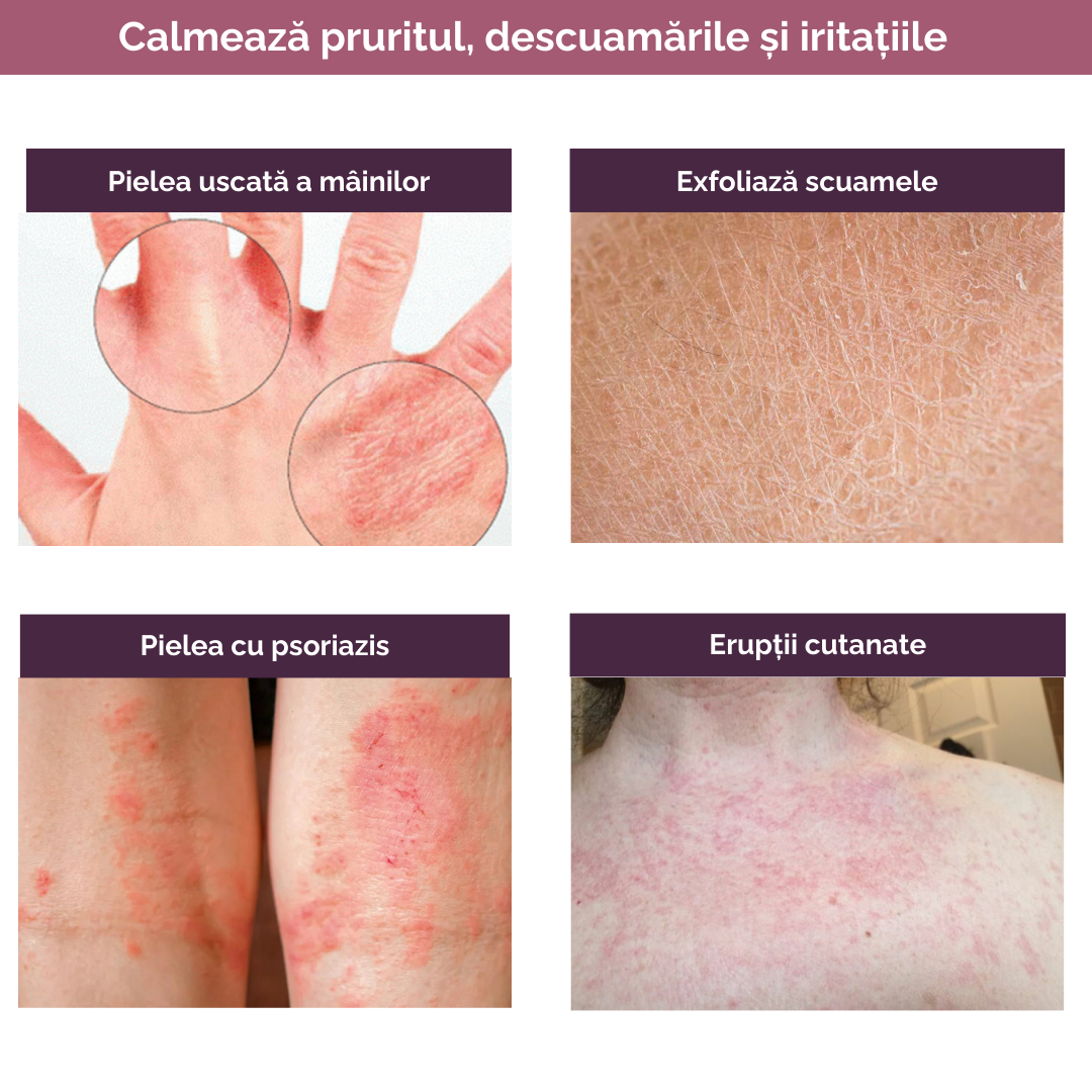 Ureea 30% - Crema cu Uree, Vitamina A si E - 50ML [5]