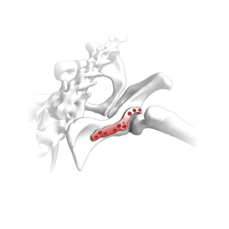 Placa Acetabular Iliaca 2.4 [2]