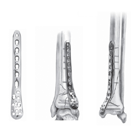 Gama HSM - Placa Blocata Tibie Distala Mediala LCP pentru suruburi de Ø 3.5