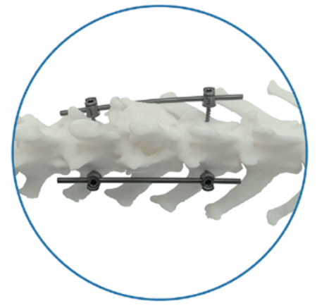 Fixare Coloana FixSpine - Suruburi Poliaxiale Coloana FixSpine