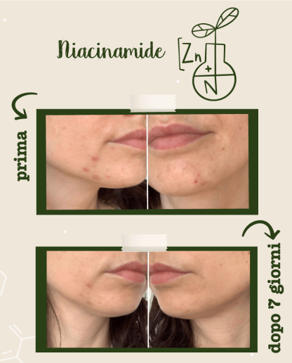 Activ pur cu Niacinamide si Zinc, 30 ml [6]