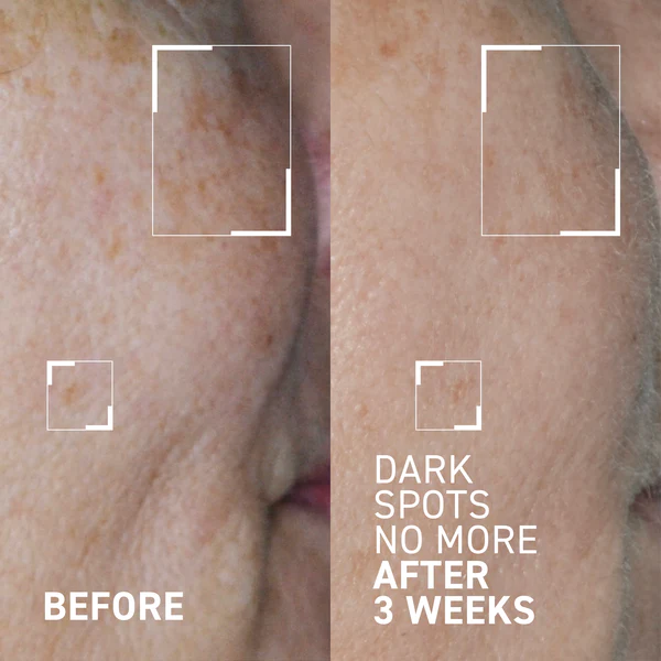Concentrat triplu cu acizi pentru minimizarea petelor Bright This Way Dark Spots No More, 15 ml, Dr. Brandt [3]