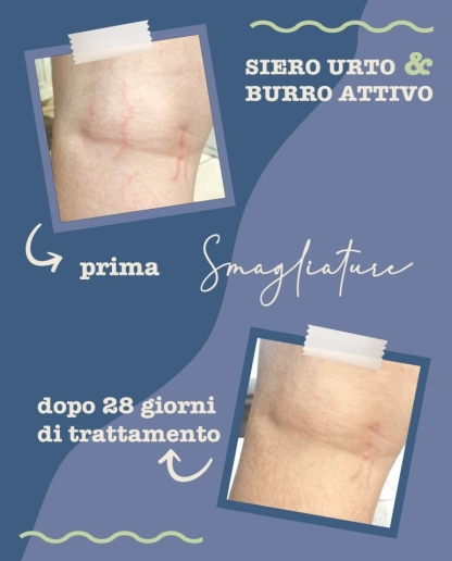 Serum pentru vergeturi, 100 ml [4]