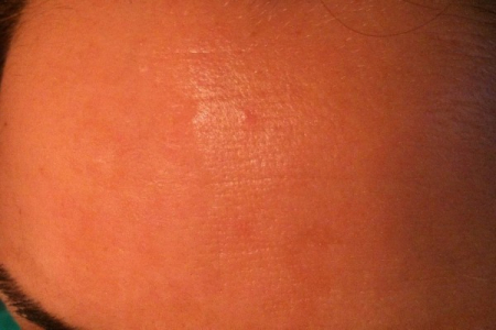 Eternal Orquid Ser de umplere a ridurilor cu Acid Hyaluronic [1]
