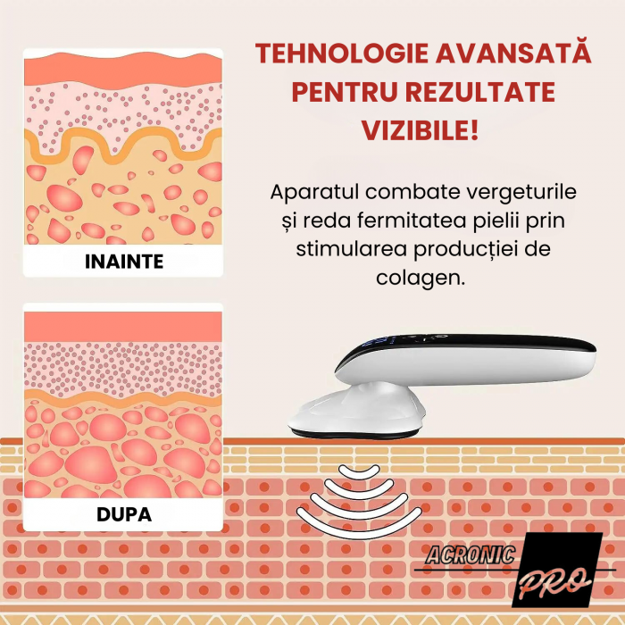 Aparat Facial AcronicPro, 10 Niveluri, Lifting si Remodelare corporala, Curatare pentru Intinerirea Pielii, Anticelulitic, Radio Frecventa, Alb [5]