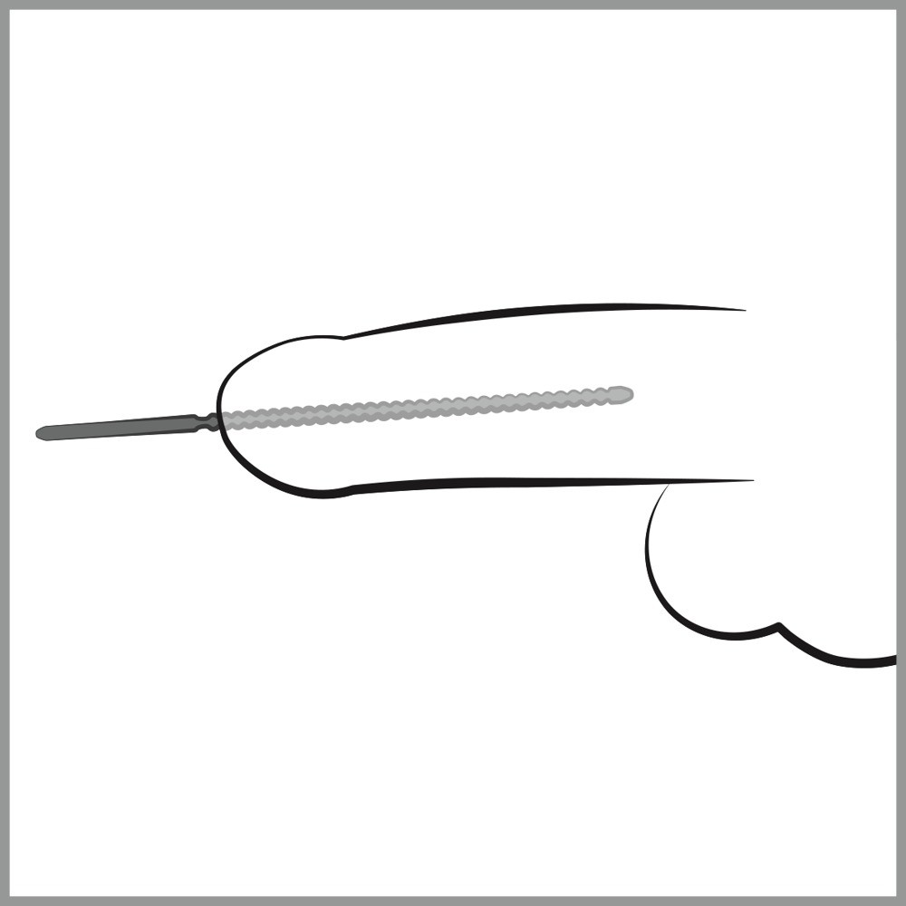 Stimulator Dilatator Uretra Barbati Penis Plug Dip Stick Ripped Ø 6 mm [3]