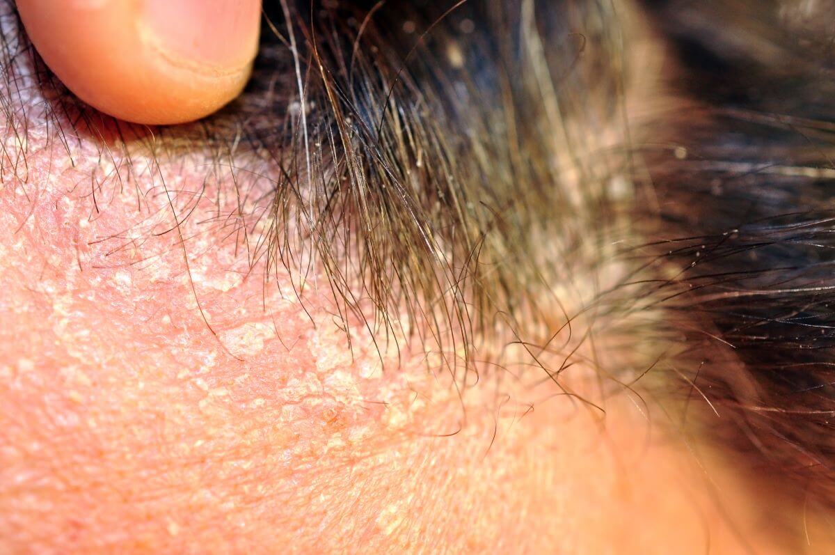 Excesul de sebum al scalpului si impactul sau asupra sanatatii scalpului si al parului dermatita seboreica la nivelul scalpului