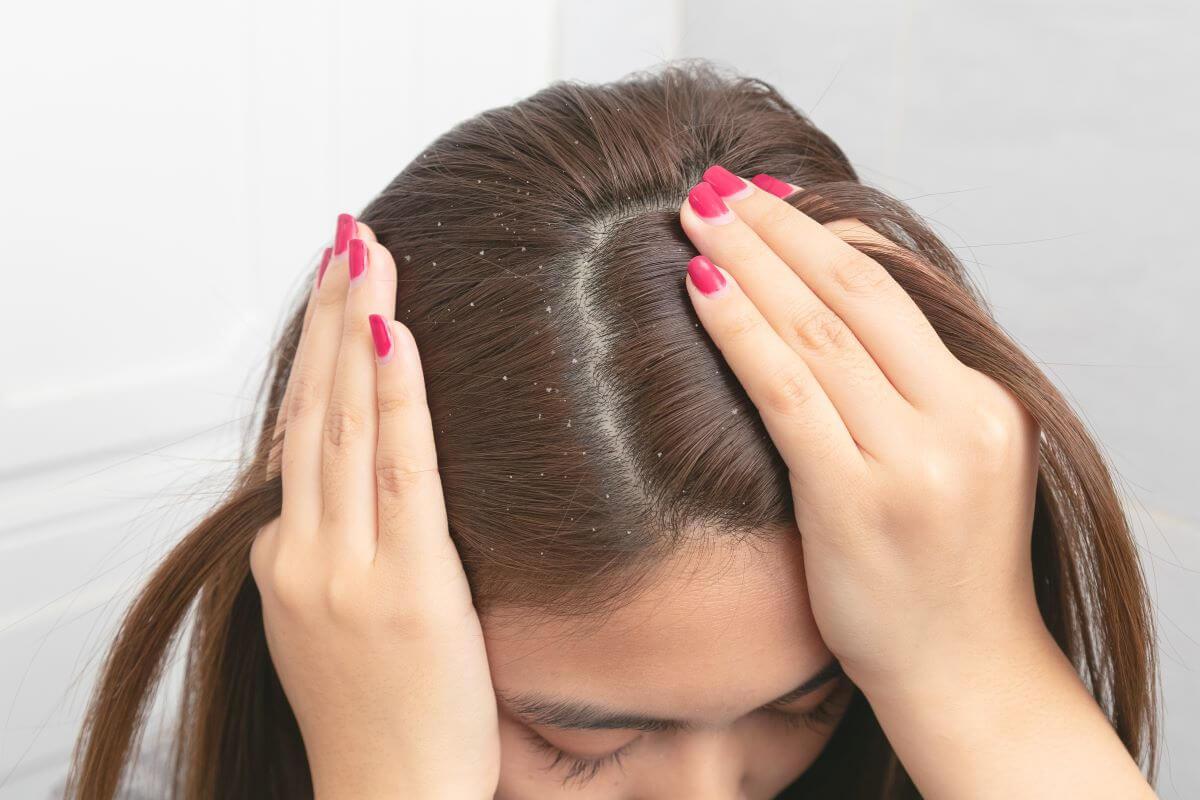 Excesul de sebum al scalpului si impactul sau asupra sanatatii scalpului si al parului scalpul unei femei cu matreata