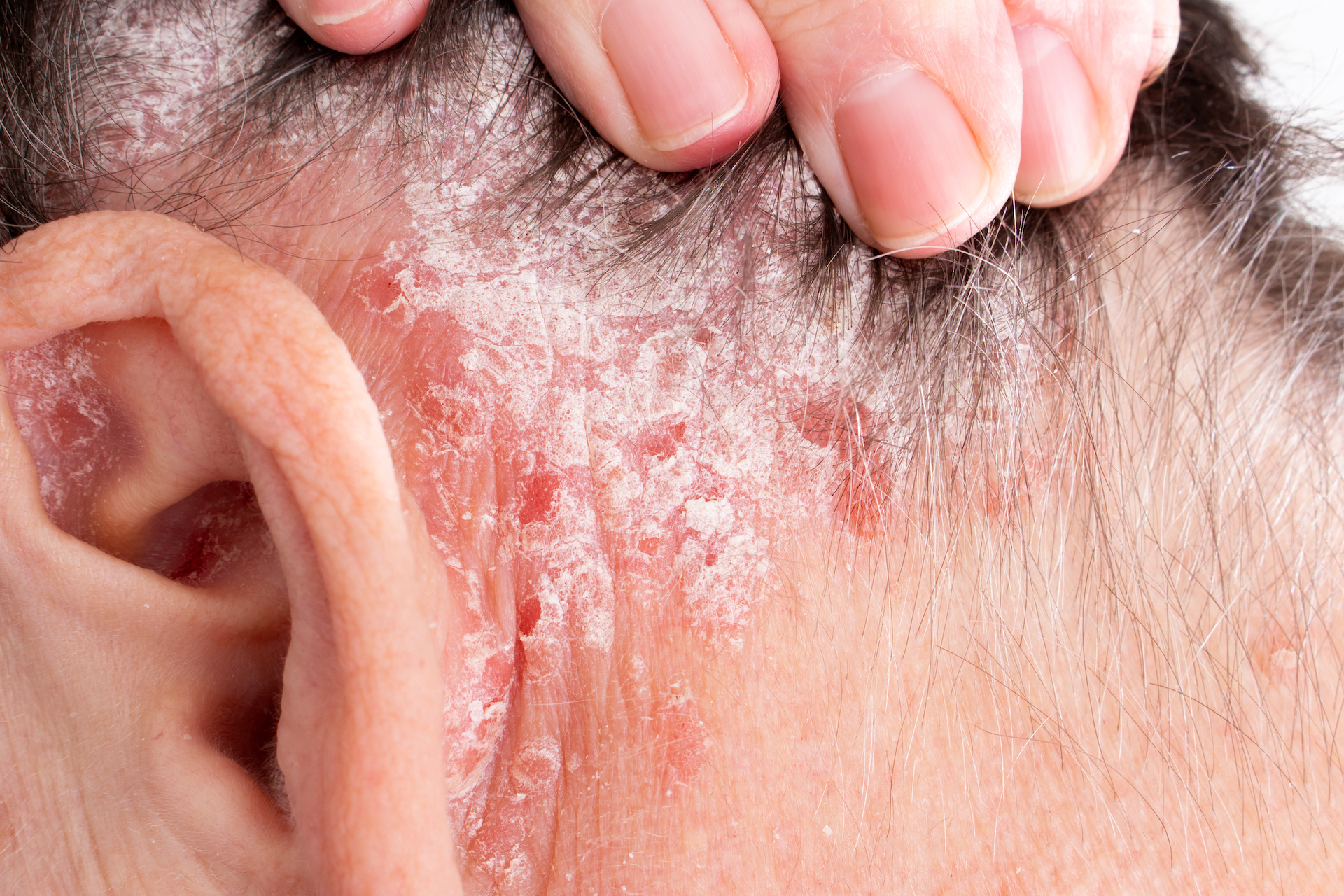 Gestionarea psoriazisului: Îngrijirea scalpului și a pielii