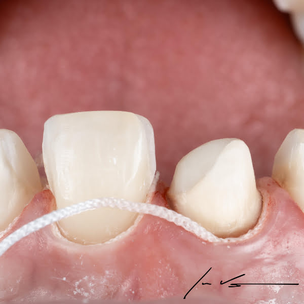 Fir de retracție gingivală PASCAL ProPak™ - Sintetic, neimpregnat, țesut [6]