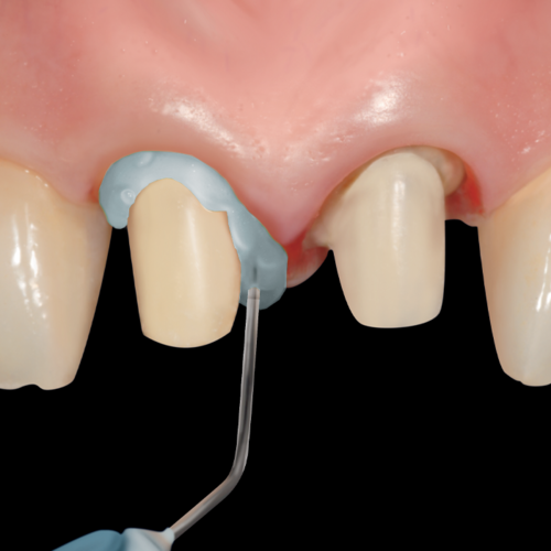 Gel hemostatic Pascal Retrax® AS Transparent - ProPack, 12 buc. [6]