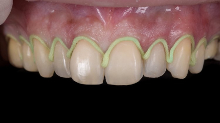 SilTrax® AS Pascal - Fir de Retracție Gingivală cu Sulfat de Aluminiu [2]