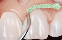 SilTrax® AS Pascal - Fir de Retracție Gingivală cu Sulfat de Aluminiu [1]