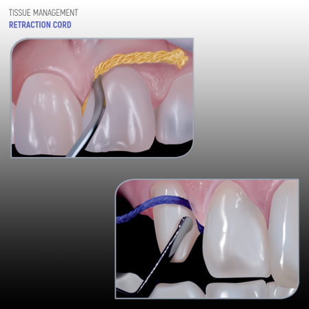 Fir de retracție gingivală neimpregnat KnitTrax™ Pascal [2]