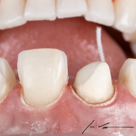 Fir de retracție gingivală PASCAL ProPak™ - Sintetic, neimpregnat, țesut [6]