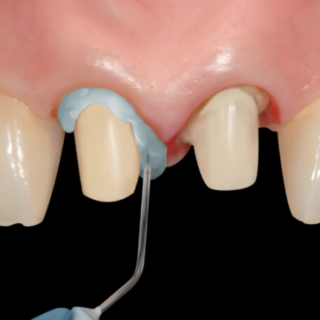 Gel hemostatic Pascal Retrax® AS Transparent - ProPack, 12 buc. [5]
