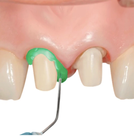 Gel hemostatic Pascal Retrax® AS Verde - ProPack, 12 buc. [3]