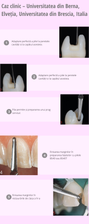 Pilă oscilantă, diamantată, cu profil convex – Intensiv Bevelshape [1]