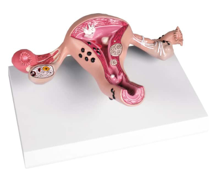 Modele Anatomie - Uter cu boli