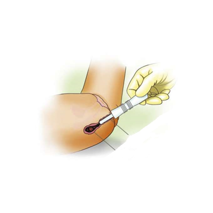Set 2 bucati sonda pentru combaterea colicilor Windi 330207-A, Alb [3]