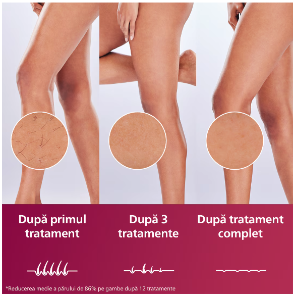 Epilator IPL Philips Lumea Seria 9900 BRI951/01, Senzor Smartskin, Tehnologie SenseIQ, Conectare la Aplicatie cu Functii Skin AI, Utilizare cu sau Fara Fir, 450.000 Impusuri, Accesoriu Fata, Corp, Axi [6]