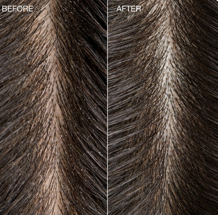 TEA TREE SPECIAL DETOX FOAMING SALT SCRUB 184GR, EXFOLIANT PENTRU SCALP [2]