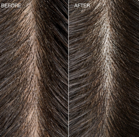 TEA TREE SPECIAL DETOX FOAMING SALT SCRUB 184GR, EXFOLIANT PENTRU SCALP [1]