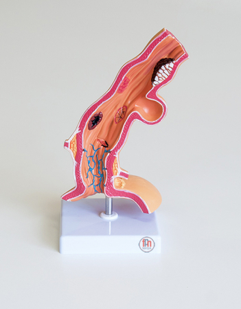 Materiale Didactice - Modelul bolii esofagiene