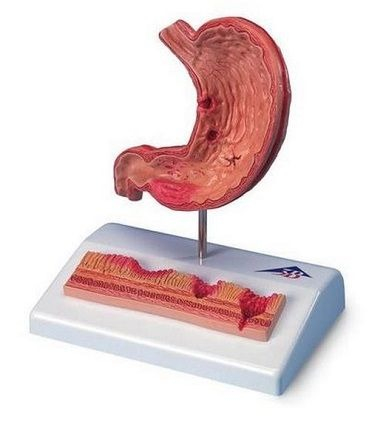 Machete anatomie - MULAJ STOMAC CU ULCER (3B)