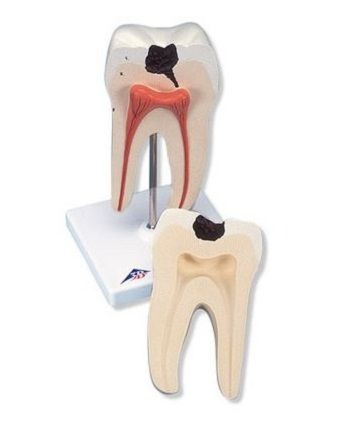 Materiale Didactice Gimnaziu si Liceu - RADACINA MOLAR INFERIOR CU PREZ CAVITATILOR(3B)