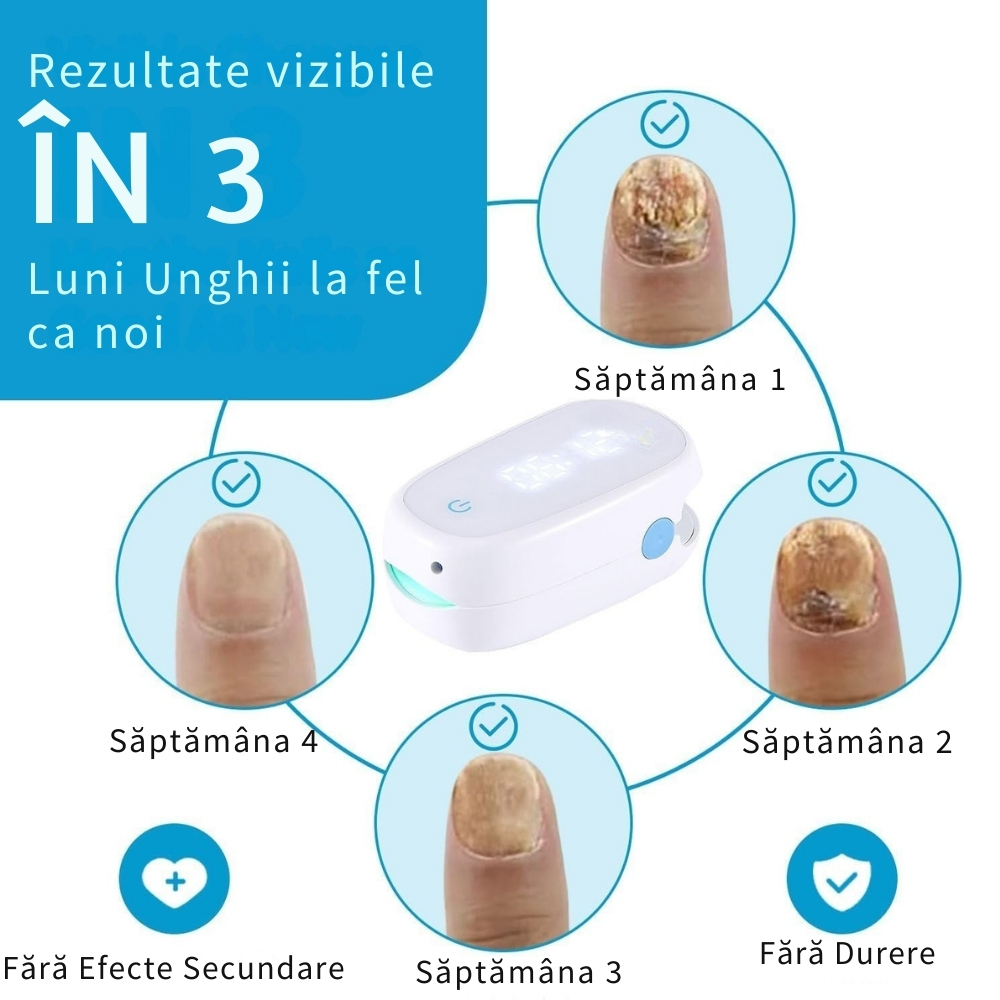 Aparat cu Laser pentru Indepartarea Onicomicozei si Tratarea Ciupercilor de Unghii, Portabil, Reancarcabil, Alb [27]