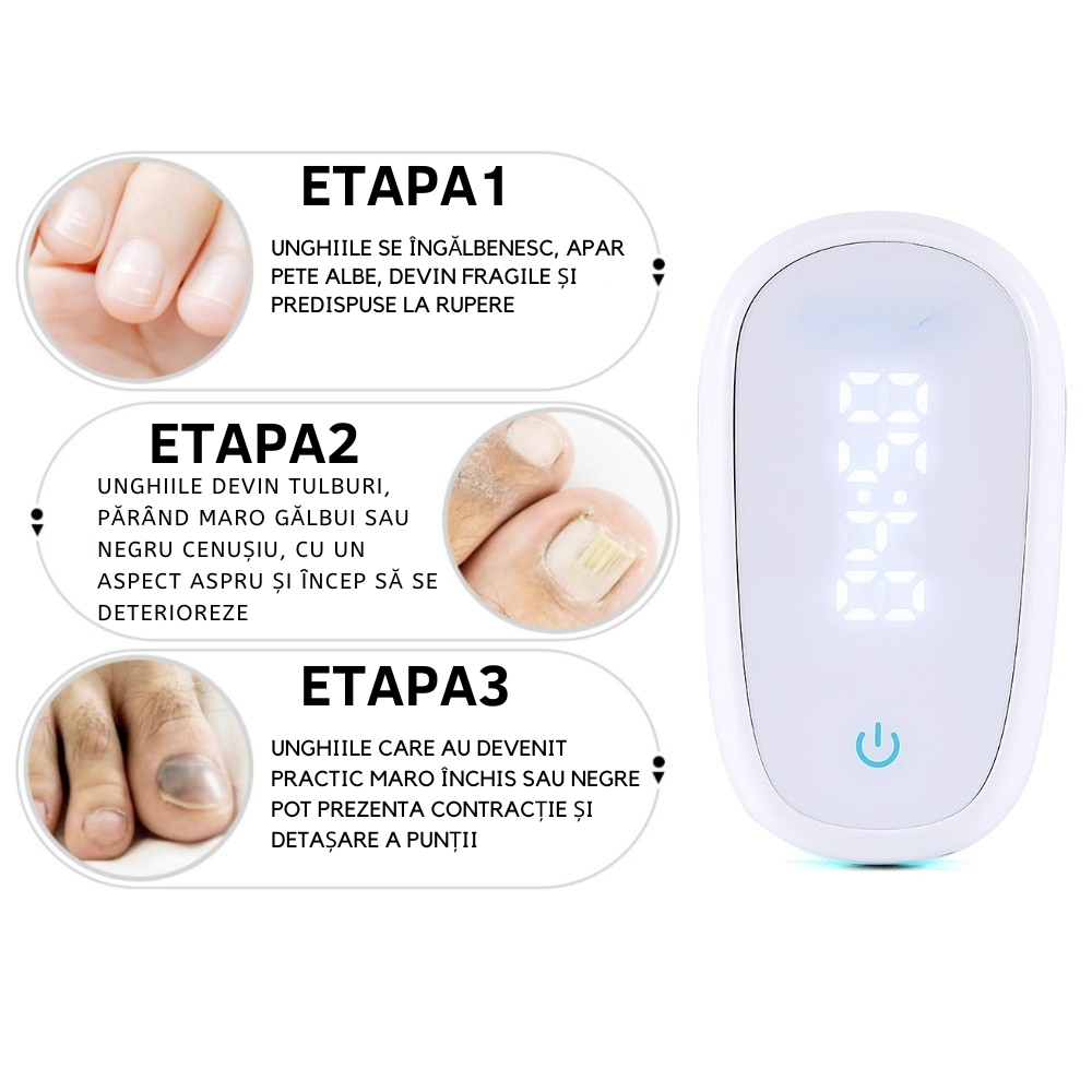 Aparat cu Laser pentru Indepartarea Onicomicozei si Tratarea Ciupercilor de Unghii, Portabil, Reancarcabil, Alb [25]