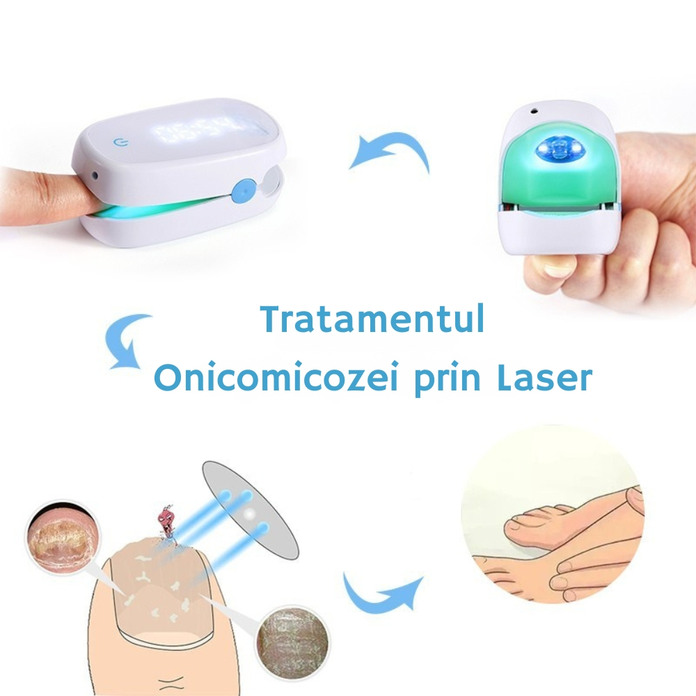 Aparat cu Laser pentru Indepartarea Onicomicozei si Tratarea Ciupercilor de Unghii, Portabil, Reancarcabil, Alb [14]