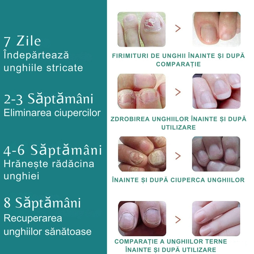 Aparat cu Laser pentru Indepartarea Onicomicozei si Tratarea Ciupercilor de Unghii, Portabil, Reancarcabil, Alb [17]