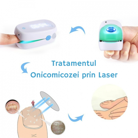 Aparat cu Laser pentru Indepartarea Onicomicozei si Tratarea Ciupercilor de Unghii, Portabil, Reancarcabil, Alb [13]