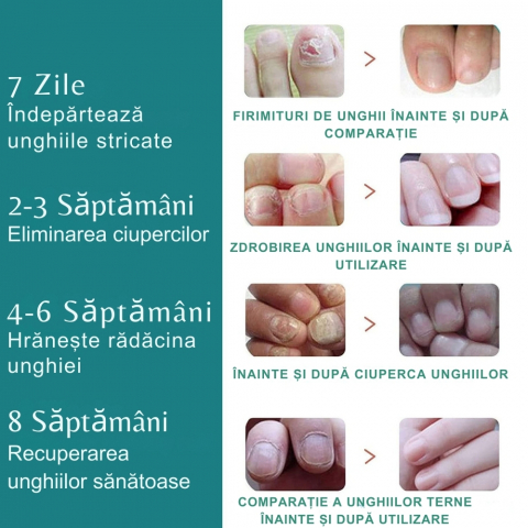 Aparat cu Laser pentru Indepartarea Onicomicozei si Tratarea Ciupercilor de Unghii, Portabil, Reancarcabil, Alb [16]